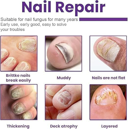 Nail Treatment Solution Serum (15ml) Buy 1 Get 1 FREE