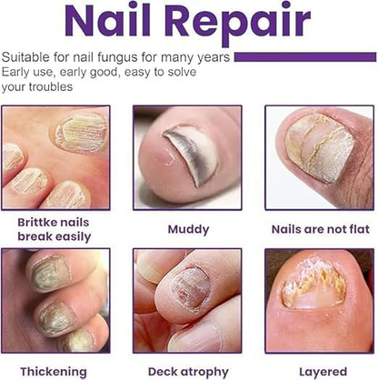 Nail Treatment Solution Serum (15ml) Buy 1 Get 1 FREE